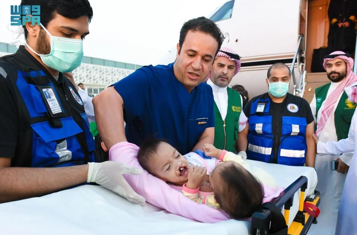 Yapışık Filipinli ikizler Potansiyel Ayrılık Ameliyatı için Suudi Arabistan'a Geliyor