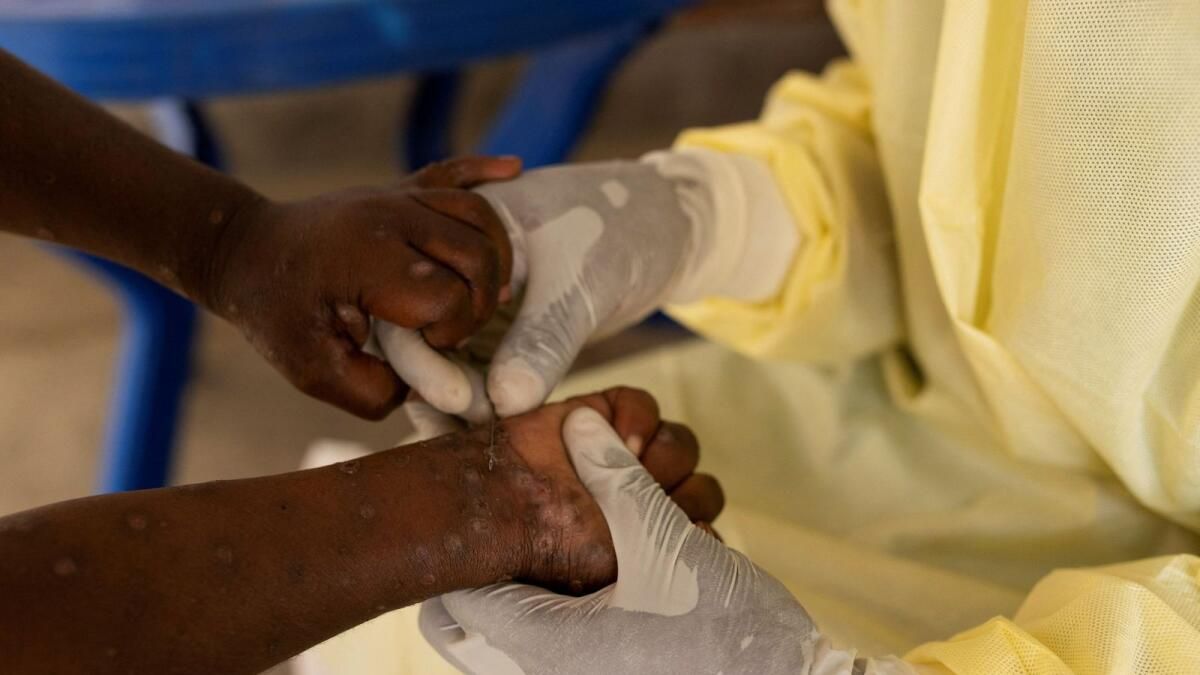 Dsö Uzmanları, Mpox'un Artık Küresel Bir Sağlık Acil Durumu Olup Olmadığını Tartışıyor