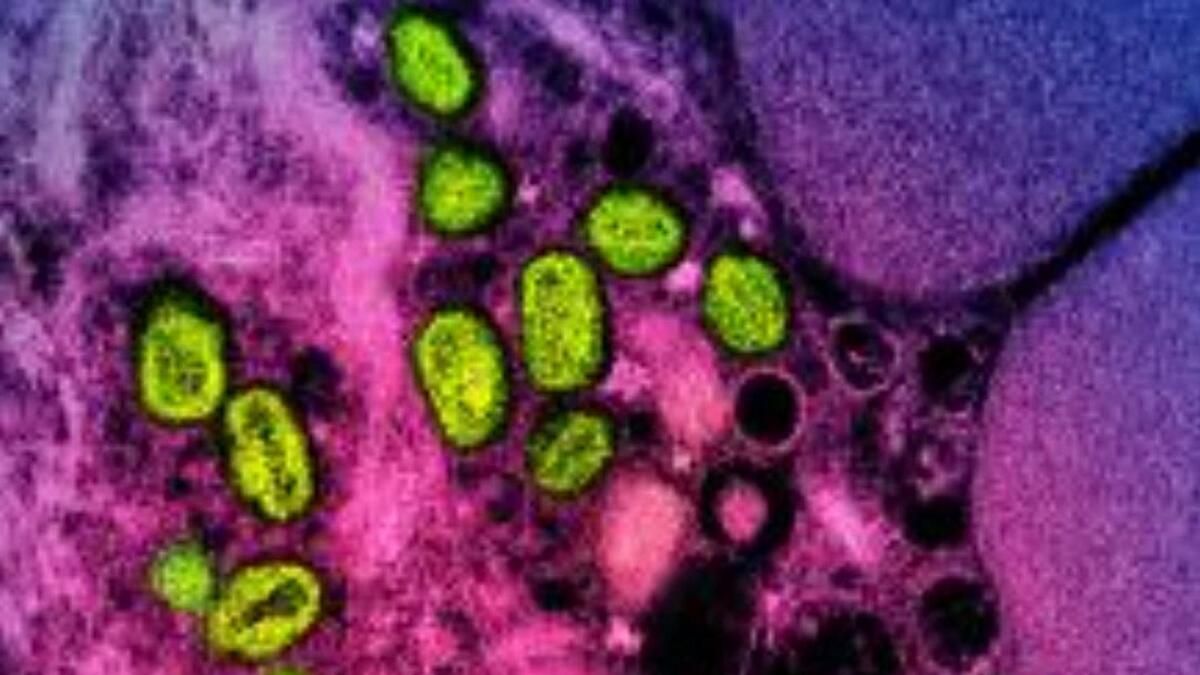 Sağlık Yetkilileri, Pakistan'da Mpox Virüsünün Tespit Edildiğini Söyledi