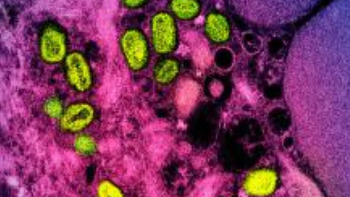 Filipinler Bu Yıl ilk Mpox Vakasını Tespit Etti