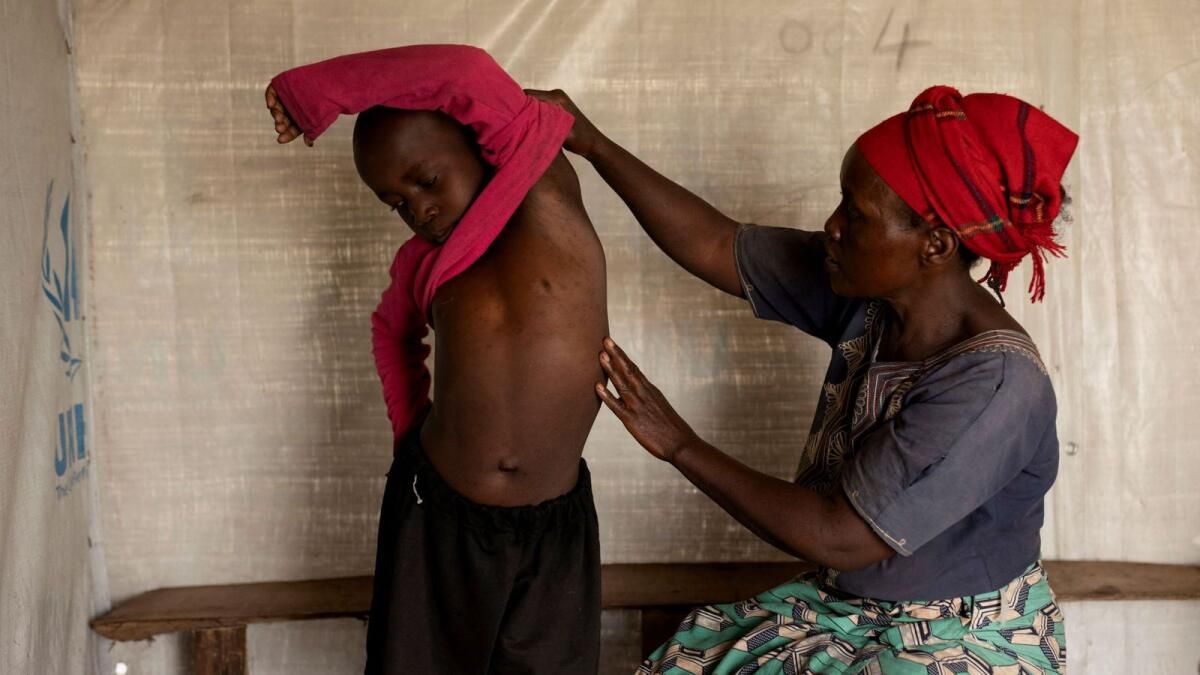 ABD Kongo'da Mpox Virüsü için ikinci Sağlık Uyarısı Yayınladı