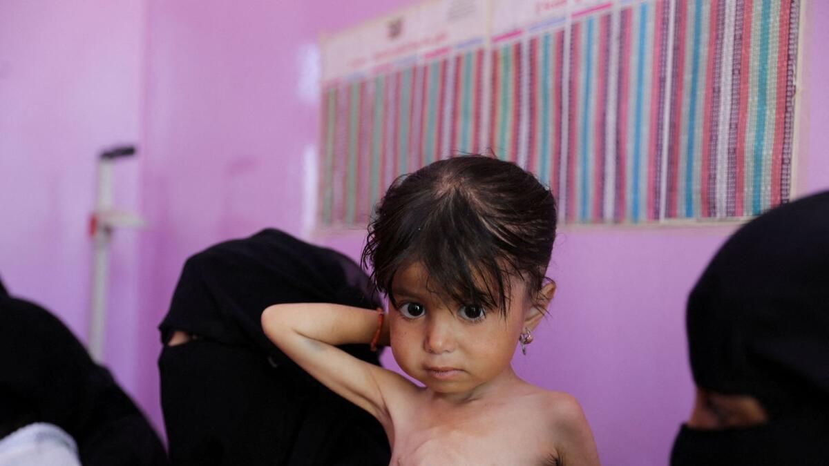 BM, Yemen'in Hükümet Kontrolündeki Bölgelerinde Yetersiz Beslenmenin Kötüleştiğini Söyledi