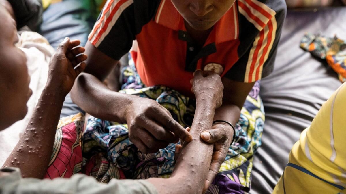 İlk Olarak Afrika'da Ruanda'da Uygulanan Mpox Aşıları