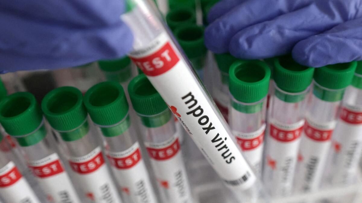 Ürdün Sağlık Bakanlığı Göçmen için Mpox Davasını Kaydetti