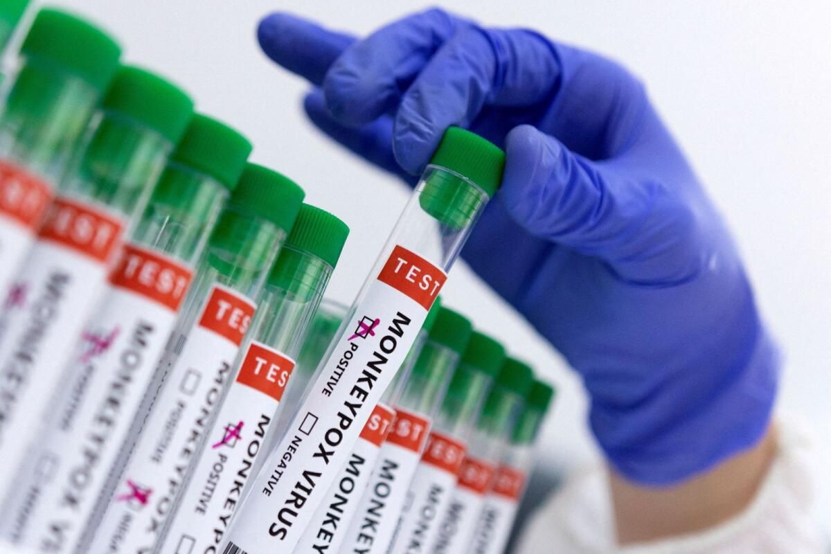 İngiltere, Yeni Mpox Varyantının İlk Vakasını Belirledi