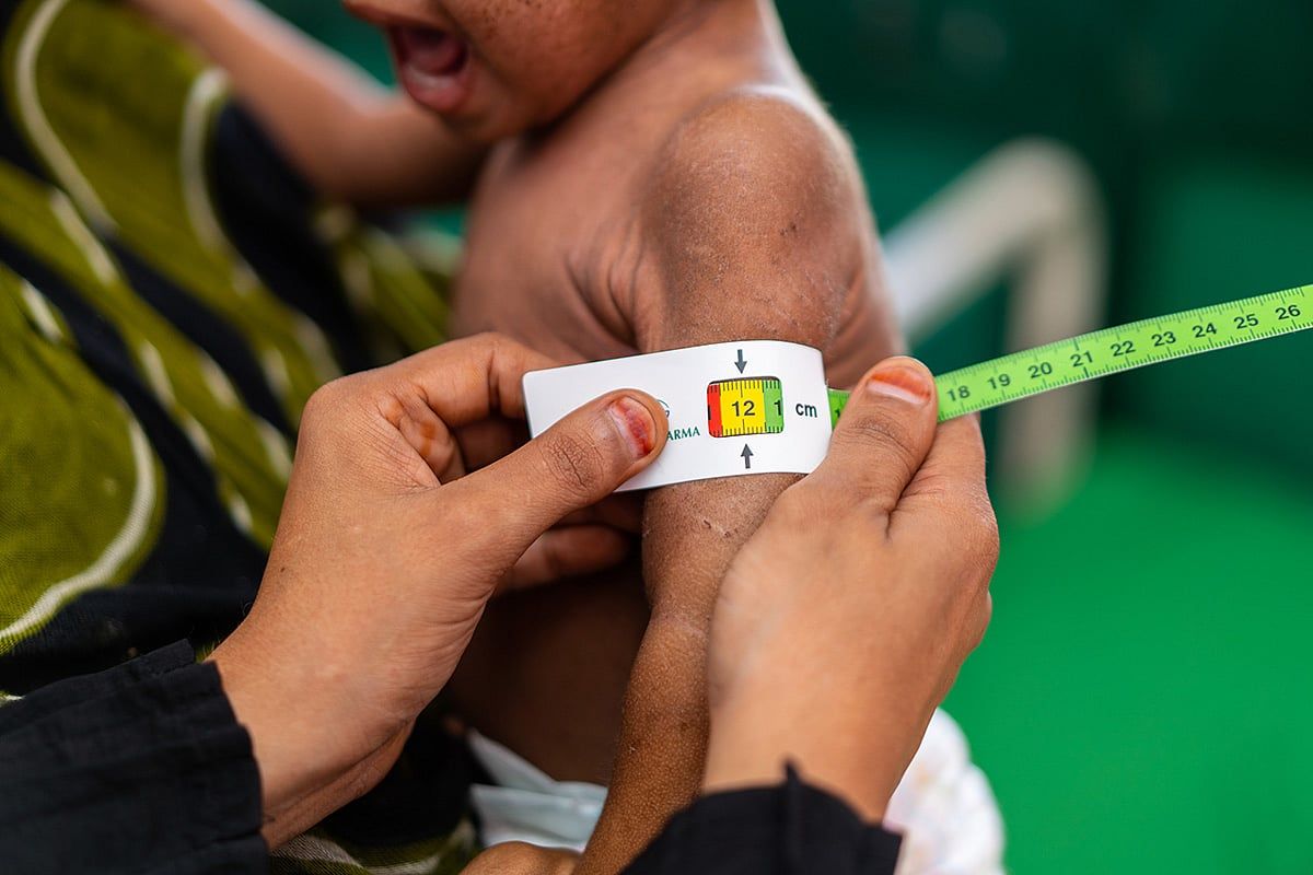 Yemen'de Yetersiz Beslenmeden Kaynaklanan Çocuk Ölümlerini %20 Azaltmak için Ortak Çaba Gösteren BAE