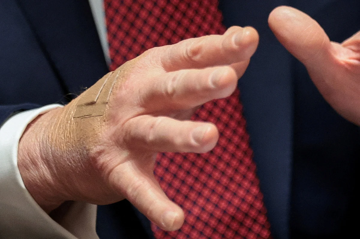 Selamlar Yaralanmalara Neden Oluyor mu? Beyaz Saray, Trump'ın Bandajlı Elini El Sıkışmalarında Suçluyor